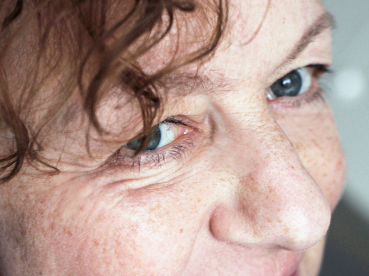 Causes & Treatment for Asymmetrical Eyes