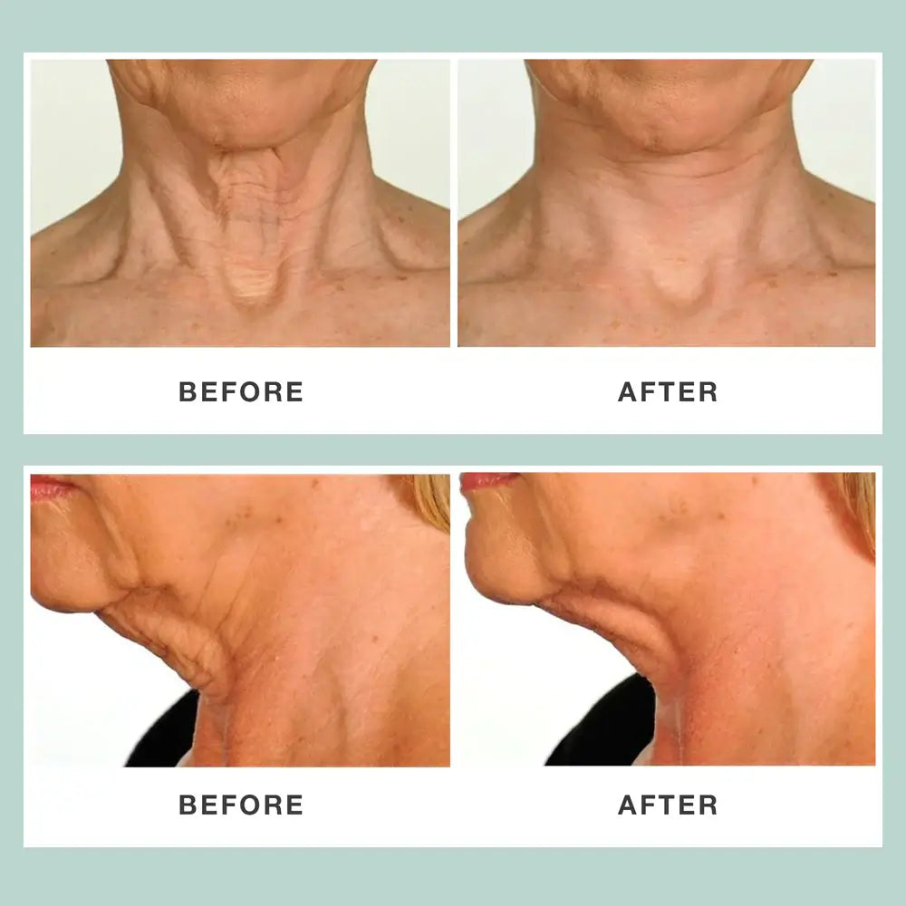 Sagging Neck Skin - Saggy Neck Treatment & Exercise