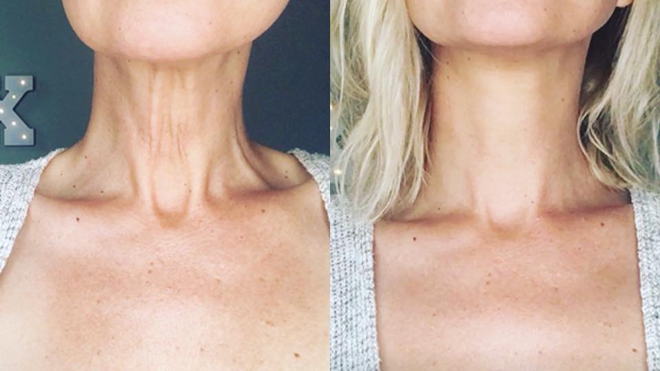 How To Tighten Neck Skin Without Surgery - Saggy Neck