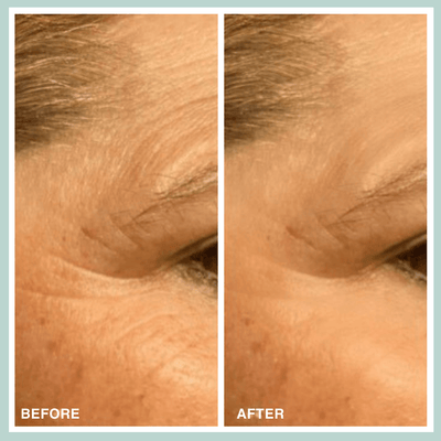Microcrystal Patch | Reduce Eye Wrinkles | Contours Rx