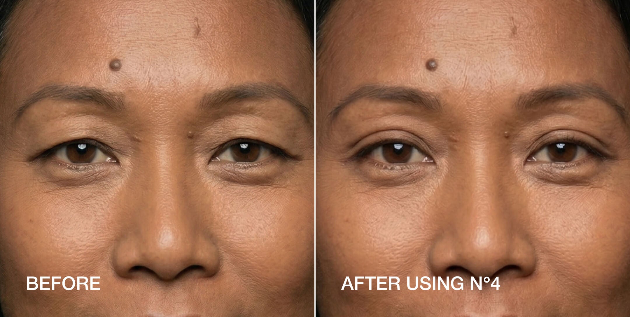 Non-surgical eyelid lift before and after — Size 4