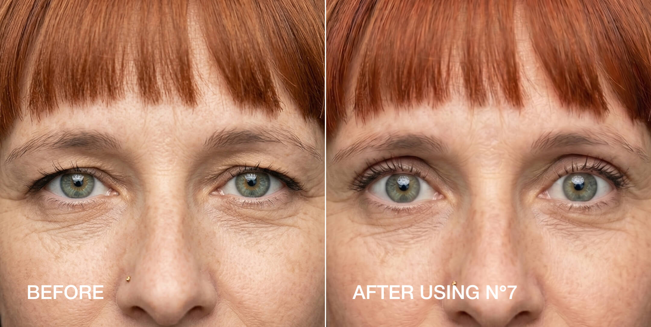Eyelid lift strips before and after — Size 7 droopy lids