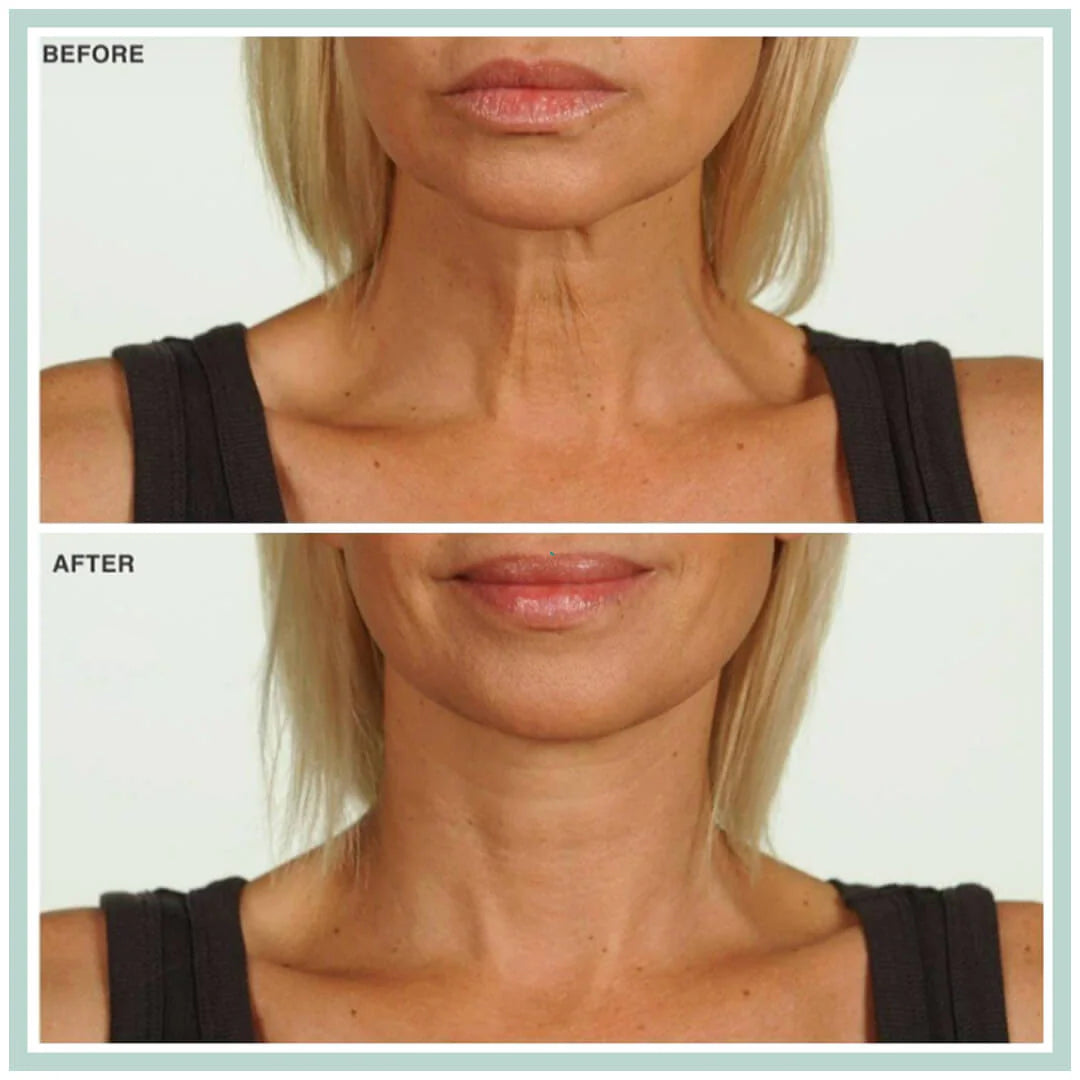 No Botox. No Surgery.